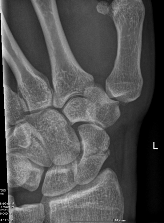 What are scaphoid fractures?