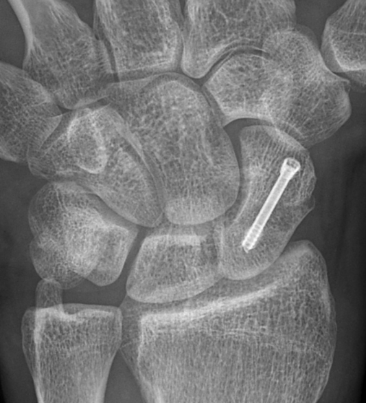 Percutaneous surgery for scaphoid fractures