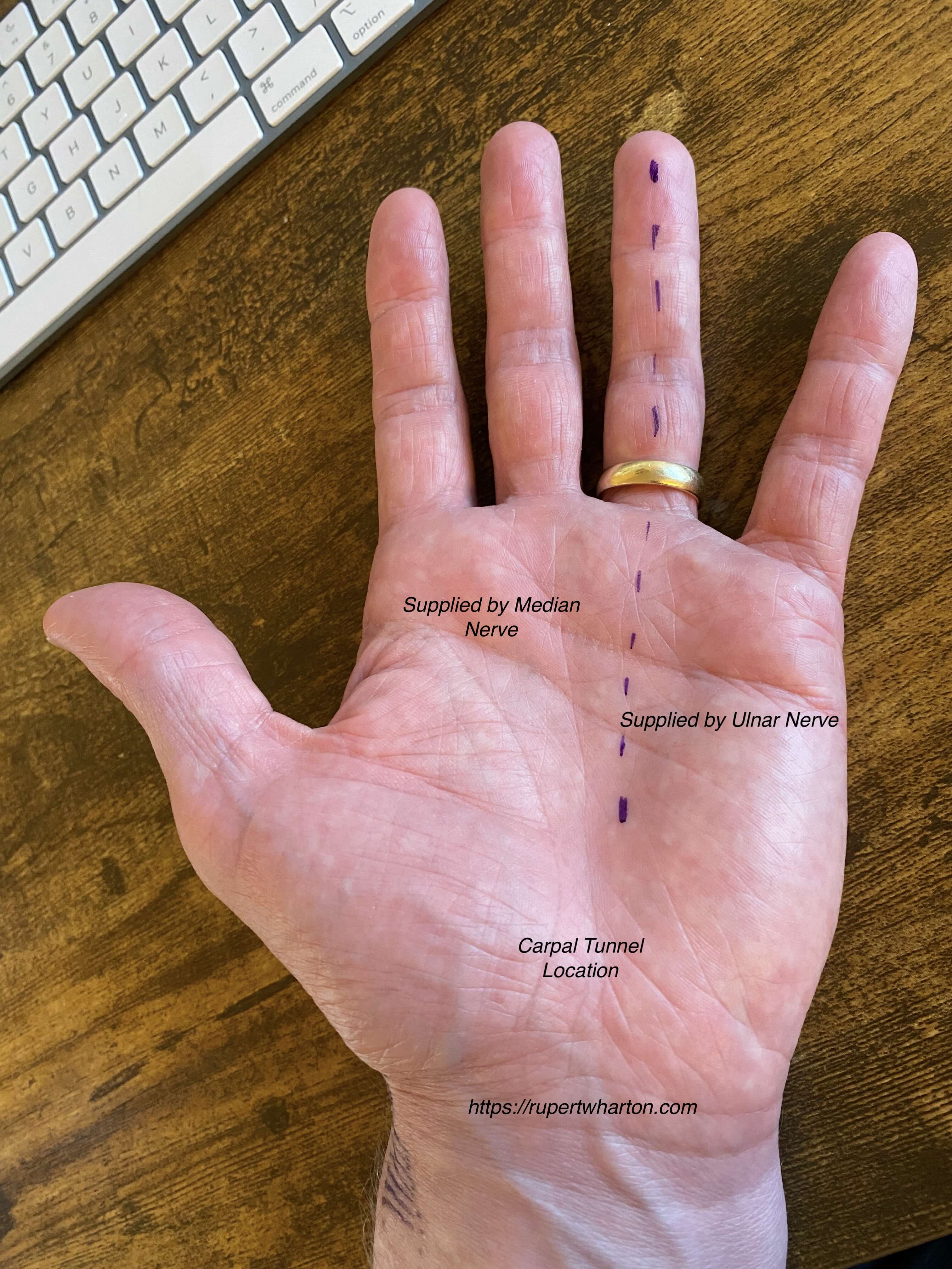 What causes tingling in the fingers? – Rupert Wharton