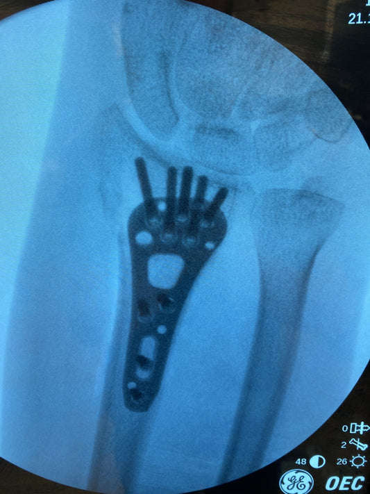 How is a distal radius fracture fixed?